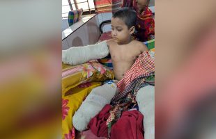 অপচিকিৎসায় হাত-পা হারানো শিশু তানভীর অবশেষে মারা গেল