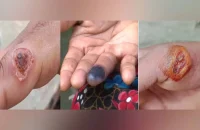 আশঙ্কাজনক হারে ছড়িয়ে পড়ছে পশুবাহিত এক অজানা রোগ