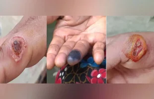 আশঙ্কাজনক হারে ছড়িয়ে পড়ছে পশুবাহিত এক অজানা রোগ