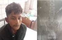 যুবকের পেট থেকে ২২ শ ইয়াবা উদ্ধার