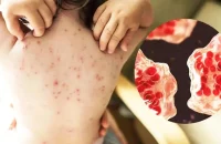 হামের তাণ্ডবে ৫৬ জেলায় হাহাকার