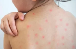 শেবাচিম হাসপাতালে হামের উপসর্গ নিয়ে শিশুর মৃত্যু