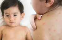 বরিশালে হাম উপসর্গ নিয়ে আরও ২ শিশুর মৃত্যু