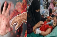 বরিশালে হামের উপসর্গ নিয়ে আরও এক শিশুর মৃ’ত্যু, হাসপাতালে ভর্তি ৩০ রোগী